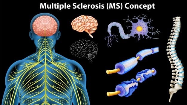 diagrama que muestra concepto esclerosis multiple 1308 3736