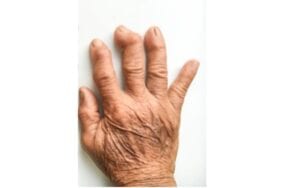Planta cara a la artritis reumatoie