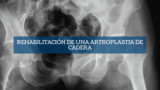 Destacada Rehabilitación de una artroplastia de cadera